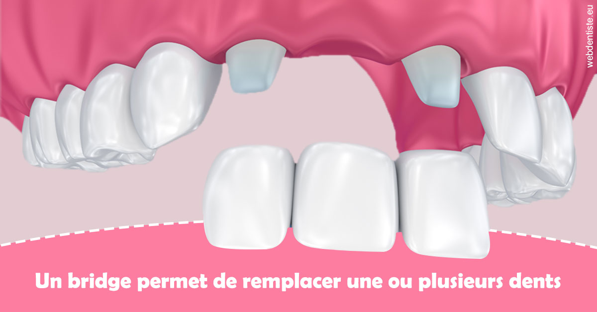 https://www.drs-wang-nief-bogey-orthodontie.fr/Bridge remplacer dents 2