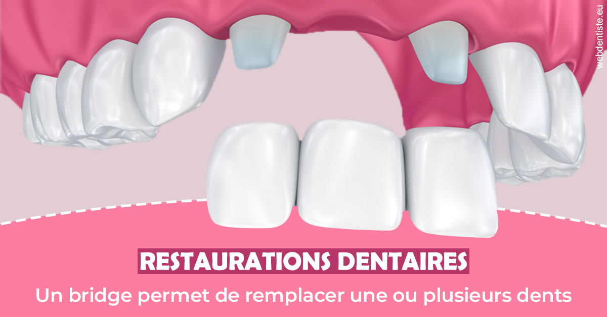 https://www.drs-wang-nief-bogey-orthodontie.fr/Bridge remplacer dents 2