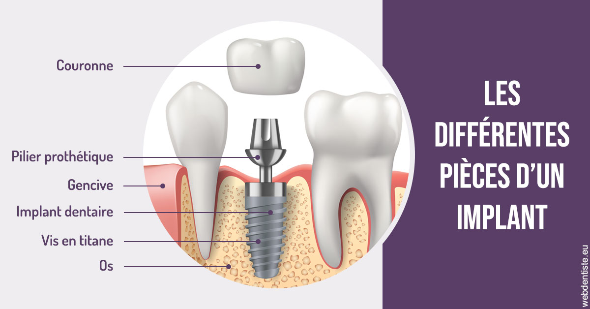 https://www.drs-wang-nief-bogey-orthodontie.fr/Les différentes pièces d’un implant 2