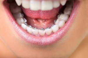 Lingual - Incognito - Orthodontiste  - Sceaux (92)