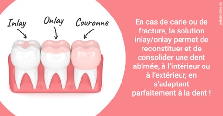 https://www.drs-wang-nief-bogey-orthodontie.fr/L'INLAY ou l'ONLAY 2